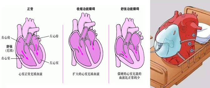 心力衰竭 心力衰竭