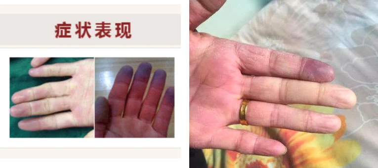 雷諾氏病 雷諾氏病